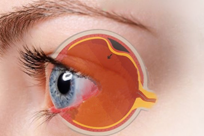 descolamento-de-retina-1400×788-1